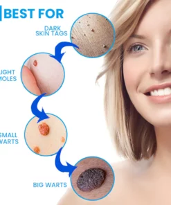 Instant Wart Removal Ointment