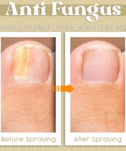 JaySuing™ Anti Fungal Treatment Spray