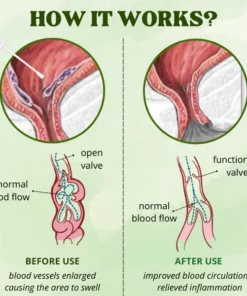 Natural Herbal Hemorrhoids Spray