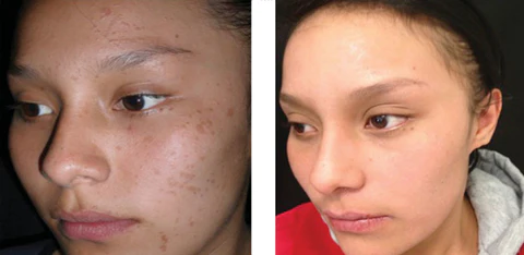 Wartoff Removal Ointmenta