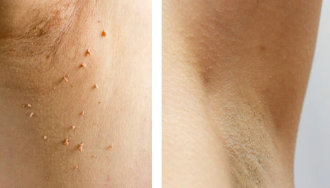 Wartoff Removal Ointmenta