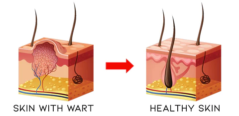 Wartoff Removal Ointmenta