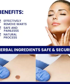 WartsoffPRO Removal Ointment