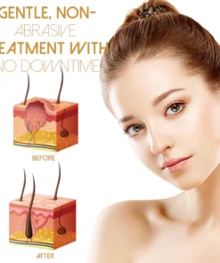 Akemi WartRemover LightTherapie Professional Kit