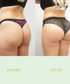 ButtUp™ Hip Lifting Essential Oil