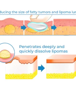 CurSkin™ Lipoma Treatment Ointment