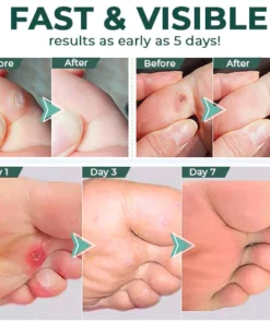 FootPro™ Corn Removal Extra Strengthen Gel