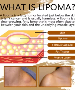 Girlsholytale™ Lipoma Removal moxibustion liquid