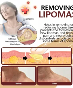 Girlsholytale™ Lipoma Removal moxibustion liquid