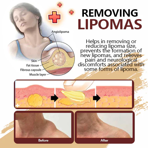Girlsholytale™ Lipoma Removal moxibustion liquid