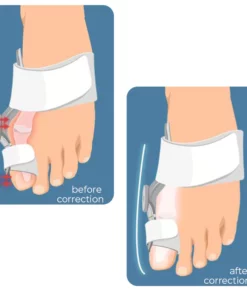 JointTech Anti Bunion Adjustable Corrector