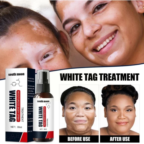 Kolmax™ vitiligo sprej na úľavu