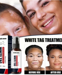 Kolmax™ Vitiligo Relief Spray