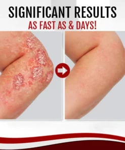 LINDIE™ Cologne Psoriasis Soap Bar