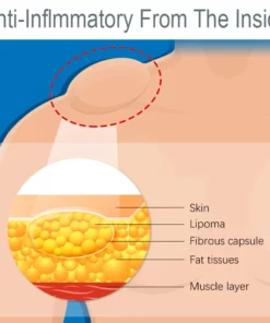 LUMPFree Herbal LipomaRemoval Cream