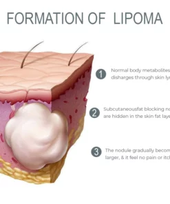 LUMPFree Herbal LipomaRemoval Cream