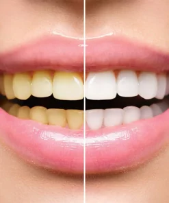 Lanthome™ Teeth Whitening Mousse