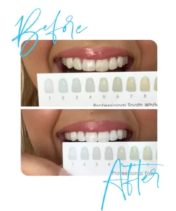 Lanthome™ Teeth Whitening Mousse