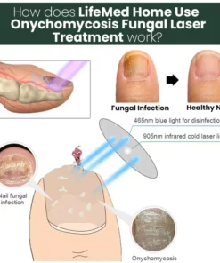 LifeMed Home Use Onychomycosis Fungal Laser Treatment