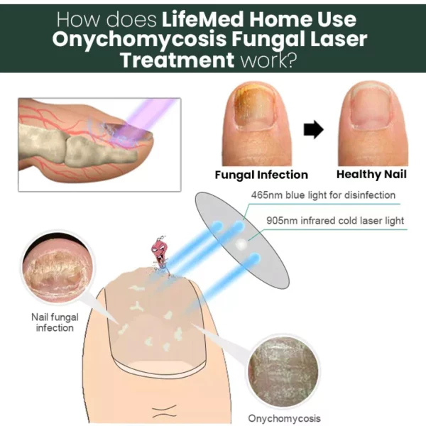 Tratamiento con láser fúngico de onicomicosis para uso doméstico de LifeMed