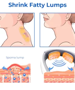 LipomaOut™ Neck EMS Ultrasonic Massager