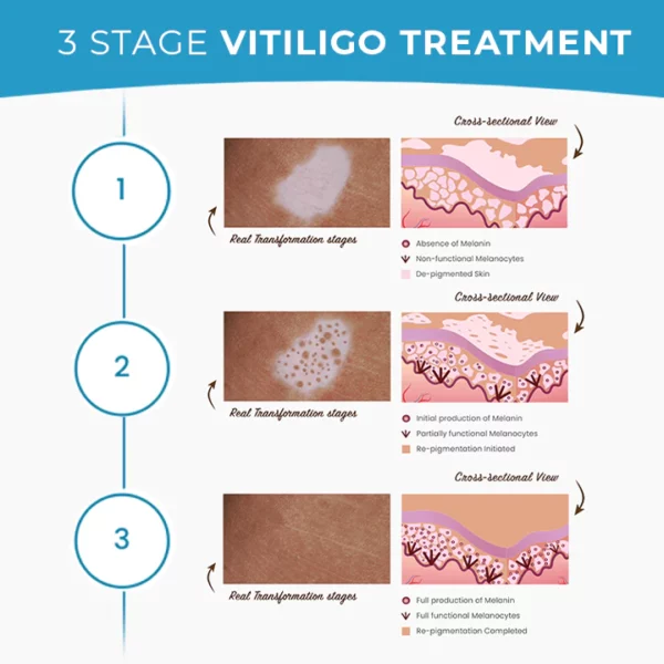 MEDix™ Cremă de tratament pentru vitiligo