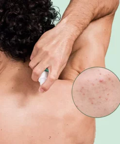 MEDix™ Back Acne Treatment Spray