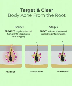 MEDix™ Back Acne Treatment Spray