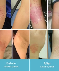 MEDix™ Eczema Treatment Spray