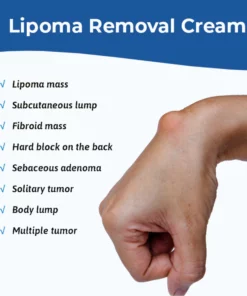 MEDix™ Lipoma Removal Cream