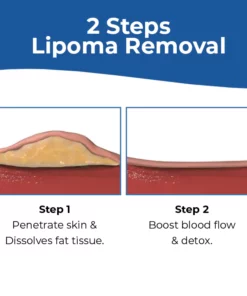 MEDix™ Lipoma Removal Cream