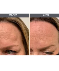 MEDix™ Lipoma Removal Cream