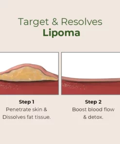 MEDix™ Lipoma Removal Patch