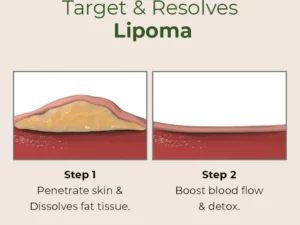 MEDix™ Lipoma Removal Patch