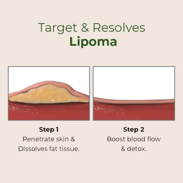 MEDix™ Lipoma Removal Patch