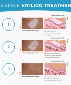 MEDix™ Vitiligo Treatment Cream