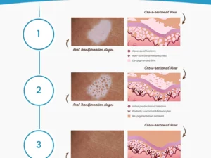 MEDix™ Vitiligo Treatment Cream