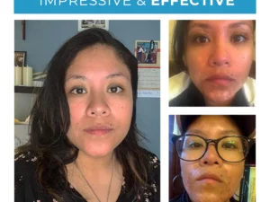 MEDix™ Vitiligo Treatment Cream