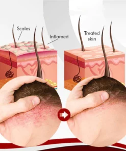 Mory™ Moisturizing Psoriasis Soap