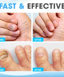 NailCure™ Fungi Treatment Pen