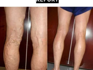 ReduceFast™ Mugwort Acupressure Detoxing&Shaping Knee Pads