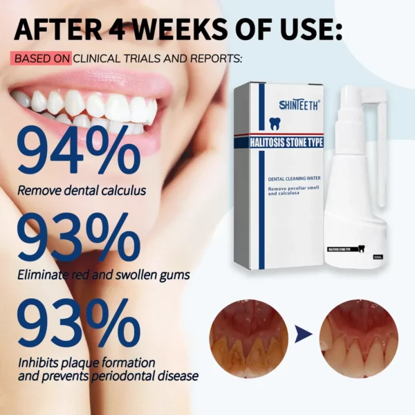ShinTeeth® Tandsteen Oplossende Krachtige Orale Spray