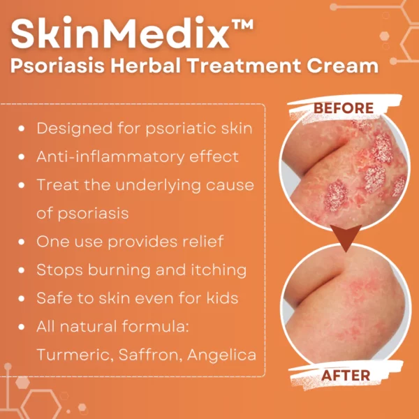 SkinMedix™ Crema de tratamento de herbas da psoríase