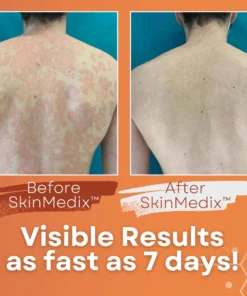 SkinMedix™ Psoriasis Herbal Treatment Cream