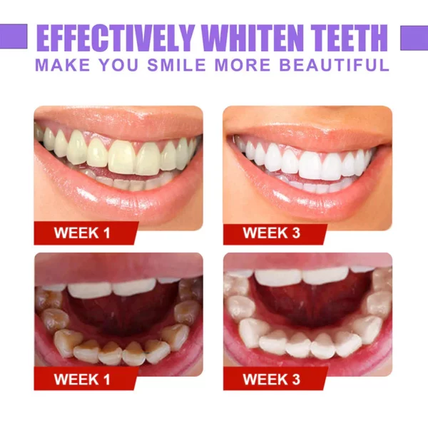 v34™ מתקן צבע שיניים - ג'ל לשיקום שיניים