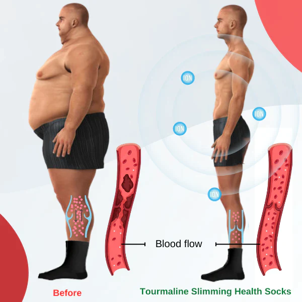 Akupunktur Slimming sọks