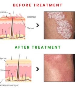 BIORAMAX Essence PsoriaRescue Treatment Spray