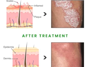 BIORAMAX PsoriaRescue Treatment Spray