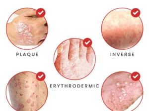 BIORAMAX PsoriaRescue Treatment Spray