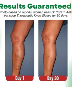Dr.Cure™ Anti-Varicose Therapeutic Knee Sleeve